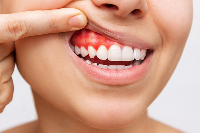 歯周基本検査（歯茎の検査）