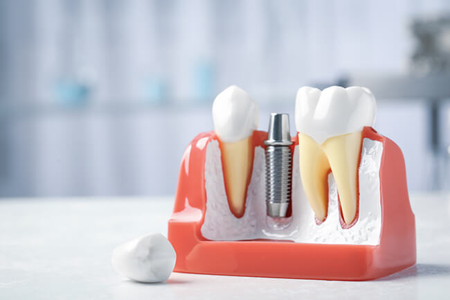 インプラントについて