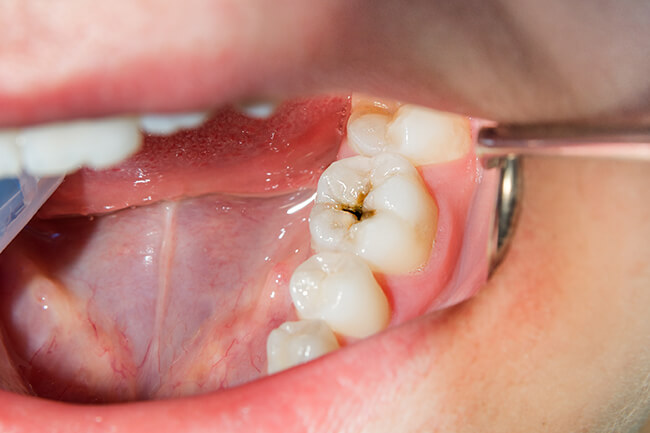 当院のむし歯治療の特長