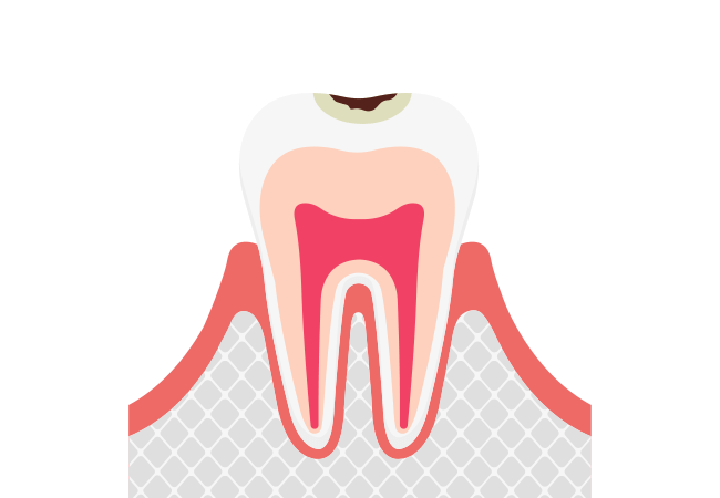 C1:エナメル質に小さな穴(初期むし歯)
