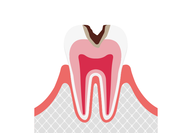 C2:象牙質まで進行