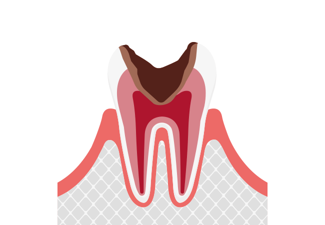 C3:神経まで進行