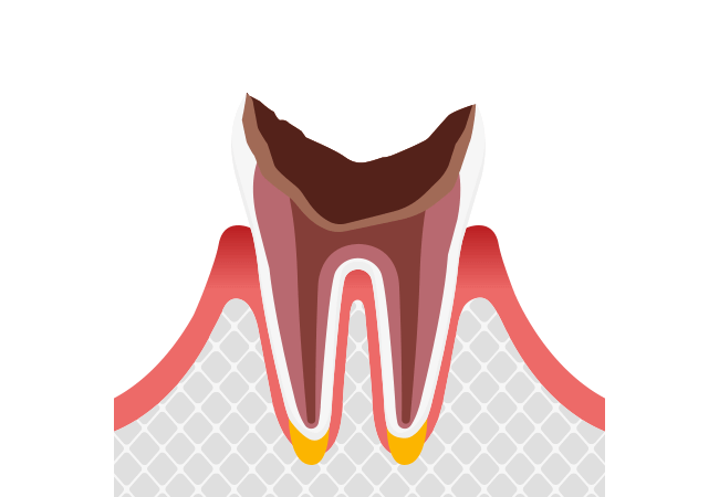 C4:歯根まで進行(末期むし歯)