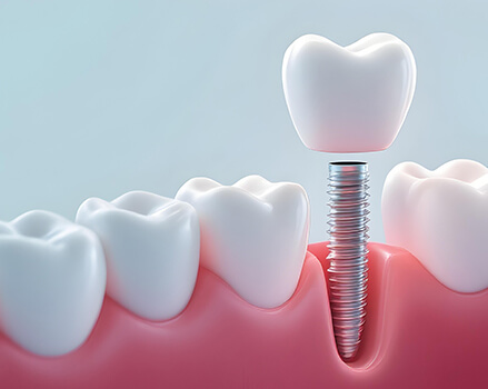インプラント治療